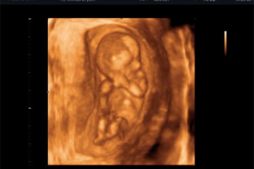 Csecsemő és gyermek ultrahang - illusztráció